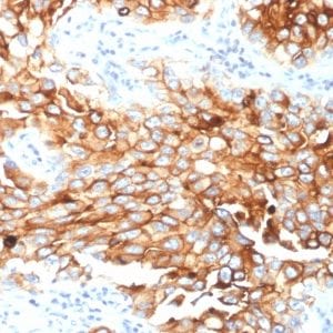 Formalin-fixed paraffin-embedded human Lung Mesothelioma stained with Mesothelin Mouse Monoclonal Antibody (MSLN/2131).
