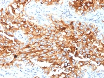 Formalin-fixed paraffin-embedded human Lung Mesothelioma stained with Mesothelin Mouse Monoclonal Antibody (MSLN/2131).