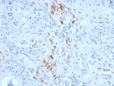 Formalin-fixed paraffin-embedded human Testicular Carcinoma stained with StAR Mouse Monoclonal Antibody (STAR/2140).