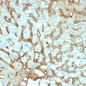 Formalin-fixed paraffin-embedded human Hepatocellular Carcinoma stained with Albumin Mouse Monoclonal Antibody (ALB/2144).