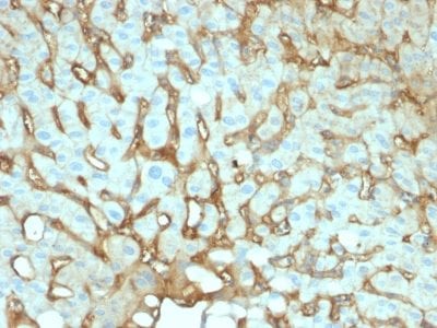 Formalin-fixed paraffin-embedded human Hepatocellular Carcinoma stained with Albumin Mouse Monoclonal Antibody (ALB/2144).