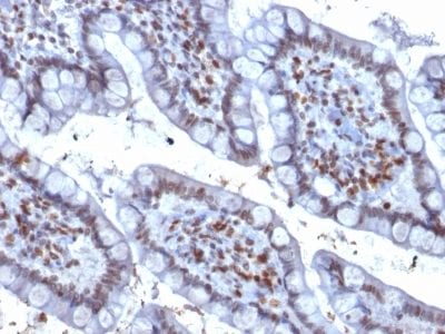 Formalin-fixed paraffin-embedded human Colon Carcinoma stained with PU.1 Mouse Monoclonal Antibody (PU1/2146).