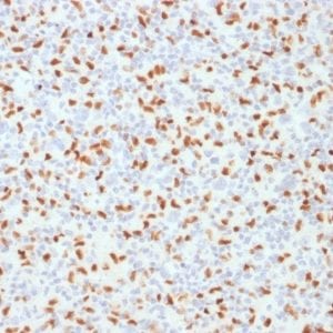 Formalin-fixed paraffin-embedded human Hodgkin’s Lymphoma stained with PU.1 Mouse Monoclonal Antibody (PU1/2146).