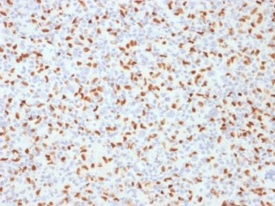 Formalin-fixed paraffin-embedded human Hodgkin’s Lymphoma stained with PU.1 Mouse Monoclonal Antibody (PU1/2146).