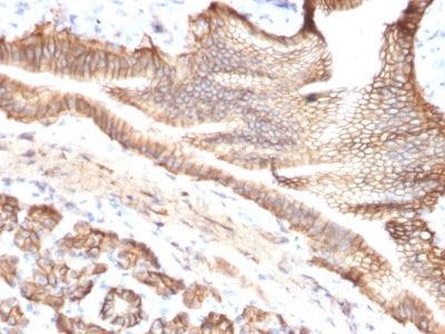 Formalin-fixed paraffin-embedded human Pancreatic Carcinoma stained with TACSTD2 / TROP2 Mouse Monoclonal Antibody (TACSTD2/2151).