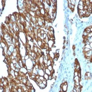 Formalin-fixed paraffin-embedded human Colon Carcinoma stained with TACSTD2 / TROP2 Mouse Monoclonal Antibody (TACSTD2/2151).