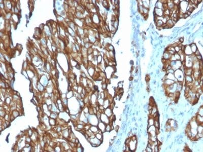 Formalin-fixed paraffin-embedded human Colon Carcinoma stained with TACSTD2 / TROP2 Mouse Monoclonal Antibody (TACSTD2/2151).