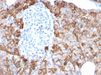 Formalin-fixed paraffin-embedded human Pancreatic Carcinoma stained with TACSTD2 / TROP2 Mouse Monoclonal Antibody (TACSTD2/2152).