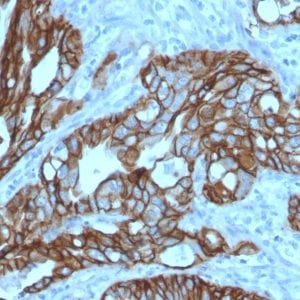 Formalin-fixed paraffin-embedded human Colon Carcinoma stained with TACSTD2 / TROP2 Mouse Monoclonal Antibody (TACSTD2/2152).