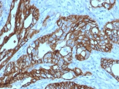 Formalin-fixed paraffin-embedded human Colon Carcinoma stained with TACSTD2 / TROP2 Mouse Monoclonal Antibody (TACSTD2/2152).