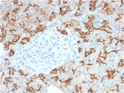 Formalin-fixed paraffin-embedded human PancreaticCarcinoma stained with TACSTD2 / TROP2Mouse Monoclonal Antibody (TACSTD2/2153).