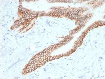 Formalin-fixed paraffin-embedded human PancreaticCarcinoma stained with TACSTD2 / TROP2Mouse Monoclonal Antibody (TACSTD2/2153).