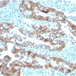 Formalin-fixed paraffin-embedded human Colon Carcinoma stained with TACSTD2 / TROP2Mouse Monoclonal Antibody (TACSTD2/2153).