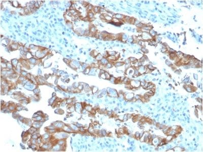 Formalin-fixed paraffin-embedded human Colon Carcinoma stained with TACSTD2 / TROP2Mouse Monoclonal Antibody (TACSTD2/2153).