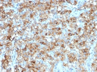Formalin-fixed paraffin-embedded human Testicular Carcinoma stained with StAR Mouse Monoclonal Antibody (STAR/2154).