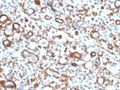 Formalin-fixed paraffin-embedded human Renal Cell Carcinoma stained with Emerin Mouse Monoclonal Antibody (EMD/2167).