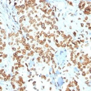 Formalin-fixed paraffin-embedded human Breast Carcinoma stained with Emerin Mouse Monoclonal Antibody (EMD/2167).
