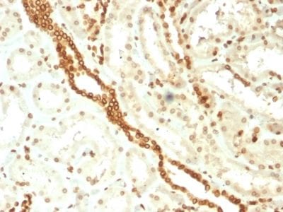 Formalin-fixed paraffin-embedded human Renal Cell Carcinoma stained with Emerin Mouse Monoclonal Antibody (EMD/2168).
