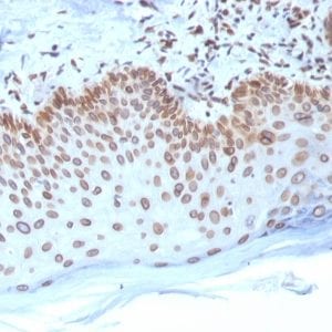 Formalin-fixed paraffin-embedded human Breast Carcinoma stained with Emerin Mouse Monoclonal Antibody (EMD/2168).