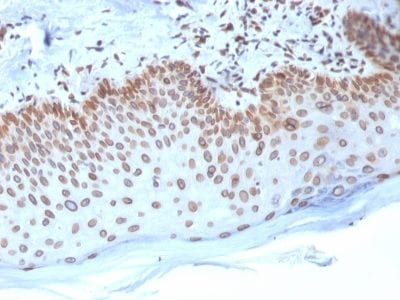 Formalin-fixed paraffin-embedded human Breast Carcinoma stained with Emerin Mouse Monoclonal Antibody (EMD/2168).