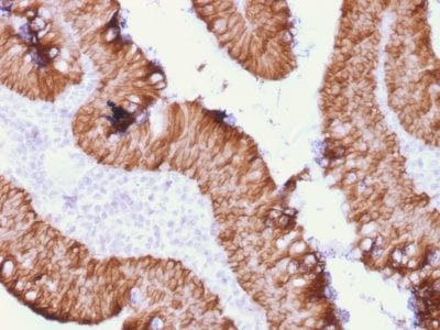 Formalin-fixed paraffin-embedded Human Rectal Mass stained with EpCAM Mouse Recombinant Monoclonal Antibody (rEGP40/1372).