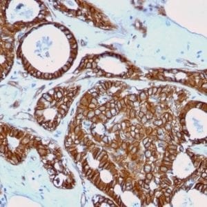Formalin-fixed paraffin-embedded human Breast Cancer stained with Beta-Catenin Mouse Recombinant Monoclonal Ab (rCTNNB1/2173).