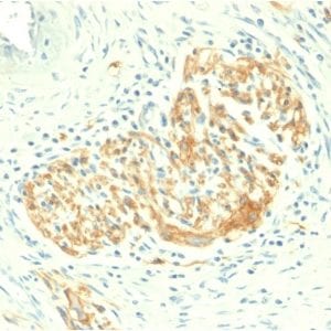 Formalin-fixed paraffin-embedded human Colon Carcinoma stained with CD56 Rabbit Recombinant Monoclonal Antibody (NCAM1/2217R).