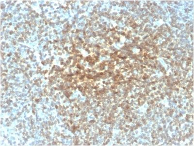 Formalin-paraffin human Follicular Lymphoma stained with Bcl-2 Mouse Recombinant Monoclonal Antibody (rBCL2/782).