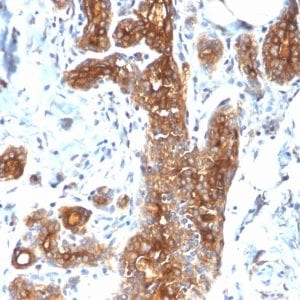 Formalin-fixed paraffin-embedded human Breast Carcinoma stained with MUC1 Rabbit Recombinant Monoclonal Antibody (MUC1/2278R).