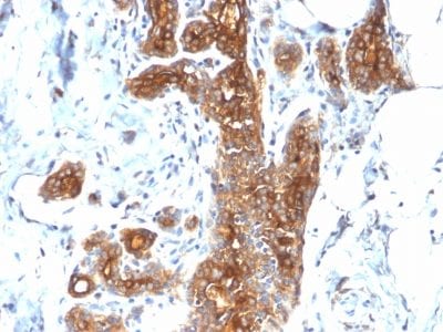 Formalin-fixed paraffin-embedded human Breast Carcinoma stained with MUC1 Rabbit Recombinant Monoclonal Antibody (MUC1/2278R).