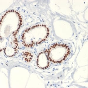 Formalin fixed paraffin embedded human Breast Carcinoma stained with Estrogen Receptor alpha Rabbit Recombinant Monoclonal Antibody (ESR1/2299R).