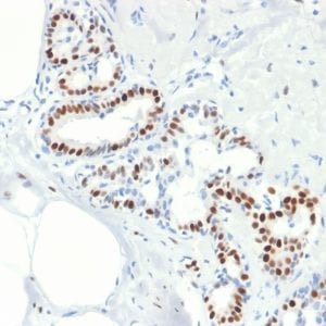 Formalin-fixed paraffin-embedded human Breast Carcinoma stained with Estrogen Receptor alpha Mouse Recombinant Monoclonal Antibody (rESR1/1935).