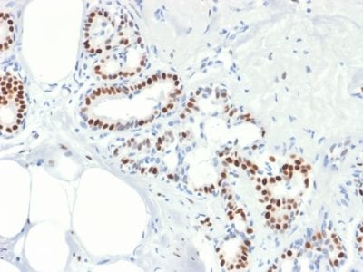 Formalin-fixed paraffin-embedded human Breast Carcinoma stained with Estrogen Receptor alpha Mouse Recombinant Monoclonal Antibody (rESR1/1935).