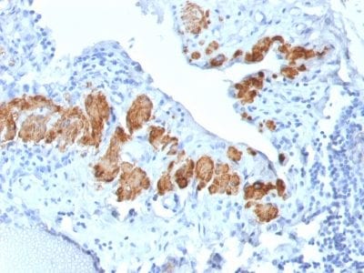 Formalin-fixed paraffin-embedded human Breast Carcinoma stained with SM-MHC Recombinant Rabbit Monoclonal Antibody (MYH11/2303R).