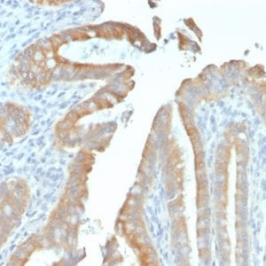 Formalin-fixed paraffin-embedded human Colon Carcinoma stained with Cytokeratin 19 Mouse Recombinant Monoclonal Antibody (rKRT19/799).