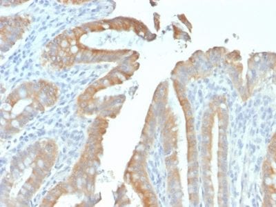 Formalin-fixed paraffin-embedded human Colon Carcinoma stained with Cytokeratin 19 Mouse Recombinant Monoclonal Antibody (rKRT19/799).