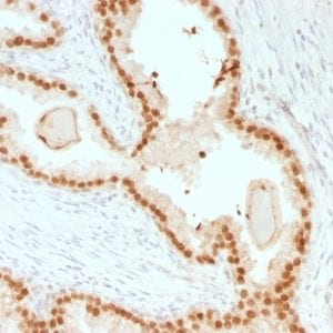 Formalin-fixed paraffin-embedded human Prostate Carcinoma stained with FOXA1 Mouse Recombinant Monoclonal Antibody (rFOXA1/1515).