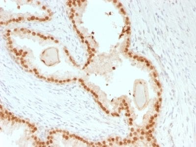 Formalin-fixed paraffin-embedded human Prostate Carcinoma stained with FOXA1 Mouse Recombinant Monoclonal Antibody (rFOXA1/1515).