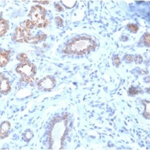 Formalin-fixed paraffin-embedded human breast cancer stained with HSP27 Mouse Recombinant Monoclonal Antibody (rHSPB1/774).
