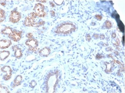 Formalin-fixed paraffin-embedded human breast cancer stained with HSP27 Mouse Recombinant Monoclonal Antibody (rHSPB1/774).