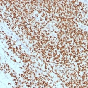 Formalin-fixed paraffin-embedded human Ewing’s Sarcoma stained with NKX2.2 Mouse Recombinant Monoclonal Antibody (rNX2/1523).