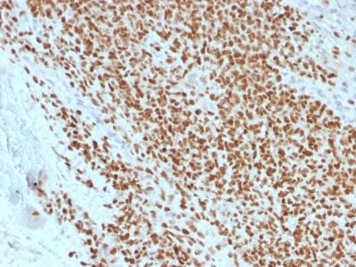 Formalin-fixed paraffin-embedded human Ewing’s Sarcoma stained with NKX2.2 Mouse Recombinant Monoclonal Antibody (rNX2/1523).