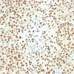 Formalin-fixed paraffin-embedded Human Melanoma stained with SOX10 Rabbit Recombinant Monoclonal Antibody(SOX10/2311R).