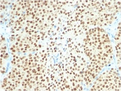 Formalin-fixed paraffin-embedded Human Melanoma stained with SOX10 Rabbit Recombinant Monoclonal Antibody(SOX10/2311R).