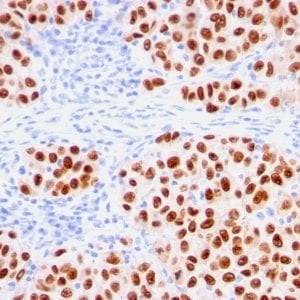 Formalin-fixed paraffin-embedded Human Melanoma stained with SOX10 Mouse Recombinant Monoclonal Antibody (rSOX10/1074).