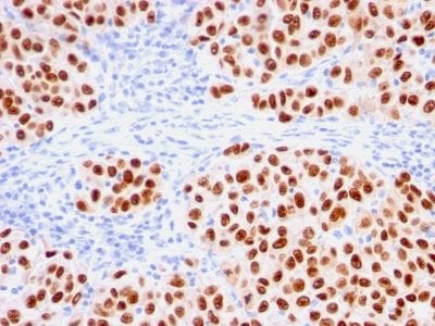 Formalin-fixed paraffin-embedded Human Melanoma stained with SOX10 Mouse Recombinant Monoclonal Antibody (rSOX10/1074).