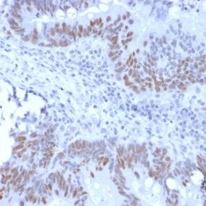 Formalin-fixed paraffin-embedded human Colon Carcinoma stained with Retinoblastoma Recombinant Rabbit Monoclonal Antibody (RB1/2313R).