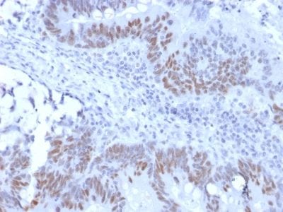 Formalin-fixed paraffin-embedded human Colon Carcinoma stained with Retinoblastoma Recombinant Rabbit Monoclonal Antibody (RB1/2313R).