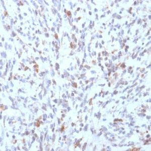 Formalin-fixed paraffin-embedded human Rhabdomyosarcoma stained with MyoD1 Mouse Recombinant Monoclonal Antibody (rMYD712).