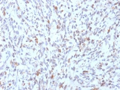 Formalin-fixed paraffin-embedded human Rhabdomyosarcoma stained with MyoD1 Mouse Recombinant Monoclonal Antibody (rMYD712).